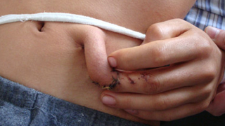 Illustration for article titled Man Grows New Fingertip On His Stomach (Warning: Gross)